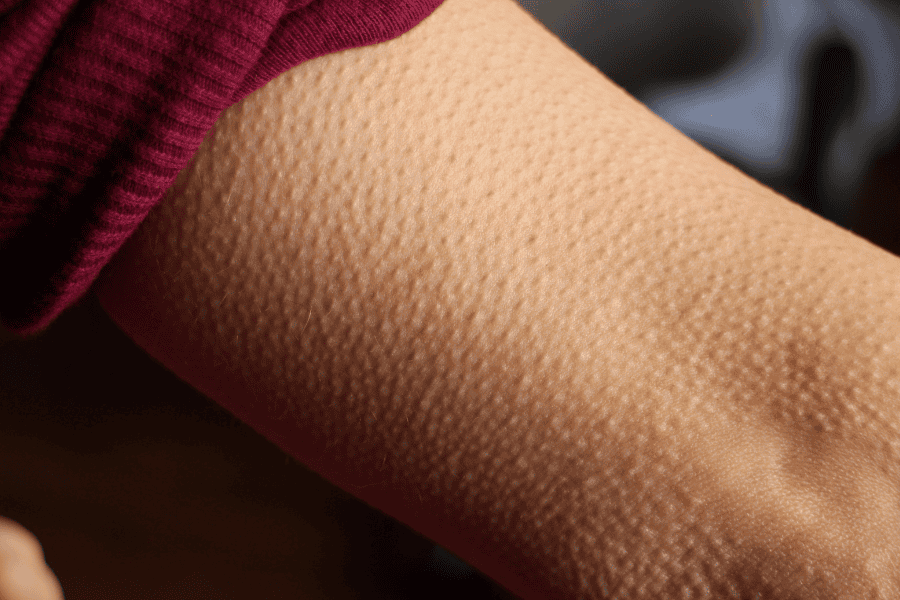 Goosebumps